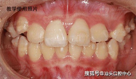 "隐身"牙套矫正牙列拥挤 经一年多矫治,爱美女孩重获自信_医生_牙齿