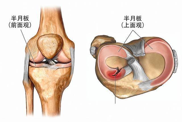 膝盖滑膜炎位置图图片