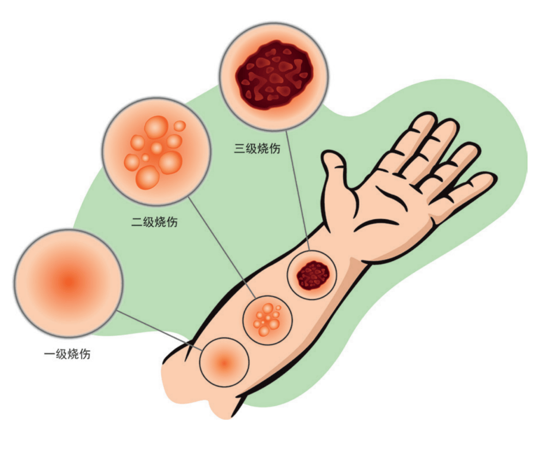 烫伤后会留疤吗 临泉治疗疤痕的医院 临泉治疗疤痕的皮肤科