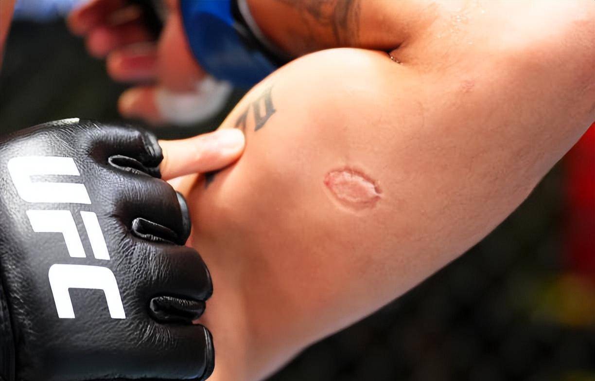 原创娜玛尤纳斯一致判定战胜里巴斯不败新秀遭犯规被咬出牙印