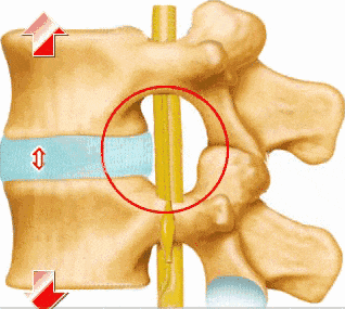 马尾综合征风险高腰45腰5骶1突出患者需警惕及时治疗是关键
