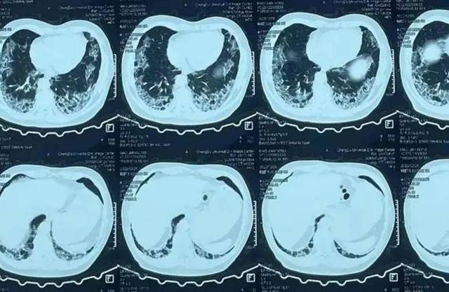 "白肺"患者越来越多,都要拍ct吗?医生:这3类人需尽早就医