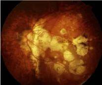 科普丨高度近视≠病理性近视!你属于哪种近视?_病变_患者_眼底