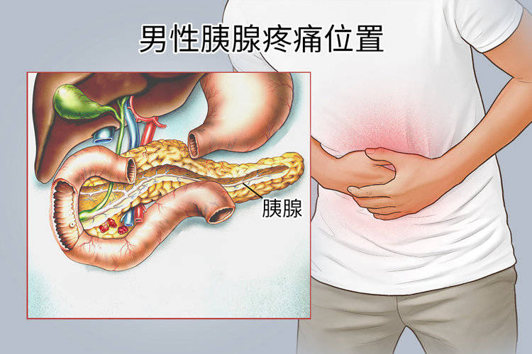 腰疼查出胰腺癌