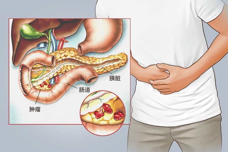 胰腺癌患者腰痛的特点有哪些(胰腺癌饭后四个征兆是什么)