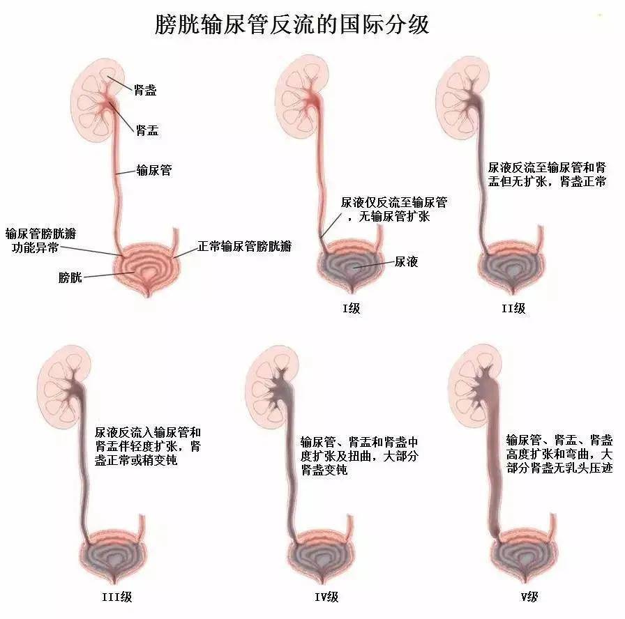预后差异大,部分无症状,可自愈,不造成肾瘢痕形成;部分可继发尿道感染