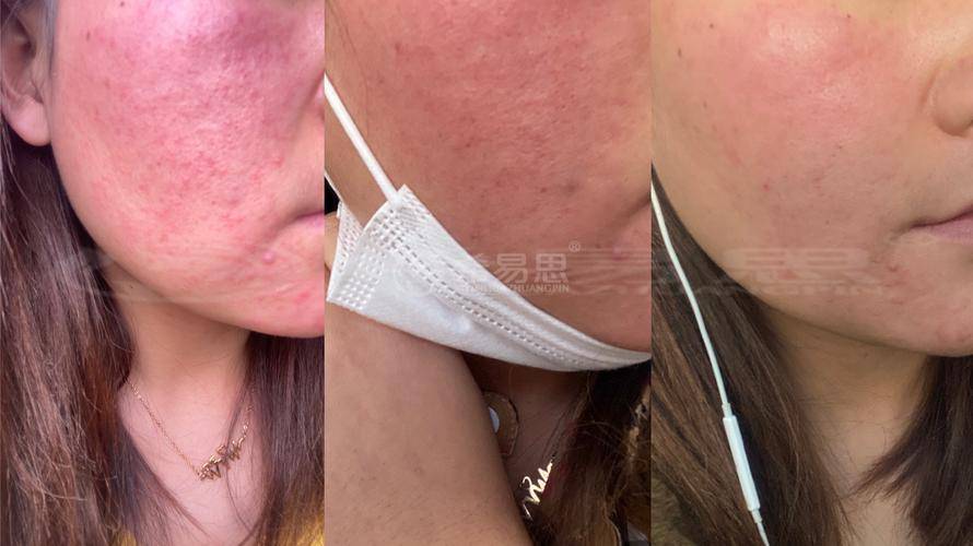 **玫瑰痤疮的救赎:eir祛痘霜,我的肌肤守护神**