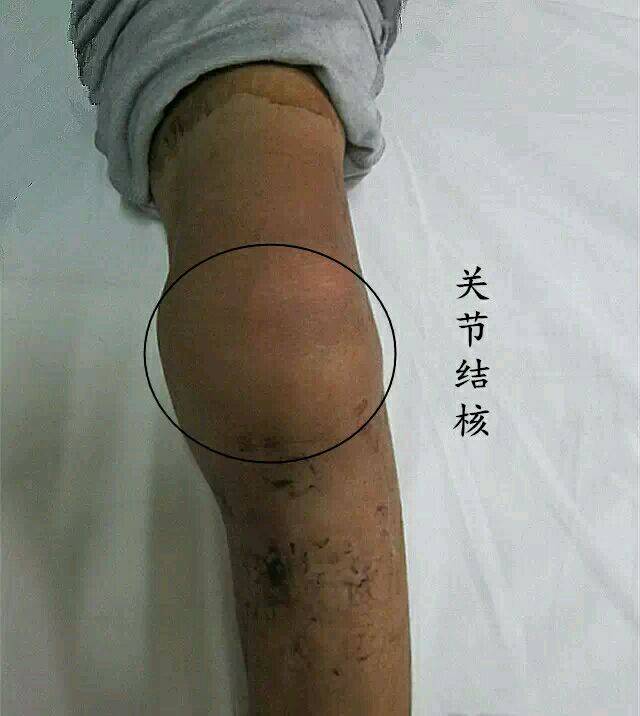 艾灸治疗滑膜炎有效果吗这种真的行吗