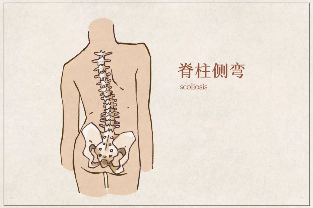 脊柱侧弯和驼背区别图图片