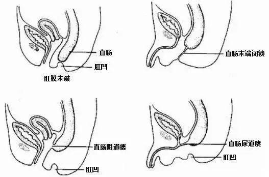 人类正常肛门外观图片