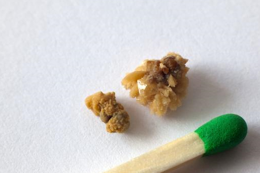 扁桃体结石由于扁桃体发炎导致周边环境变差,出现很多隐窝,当我们进食