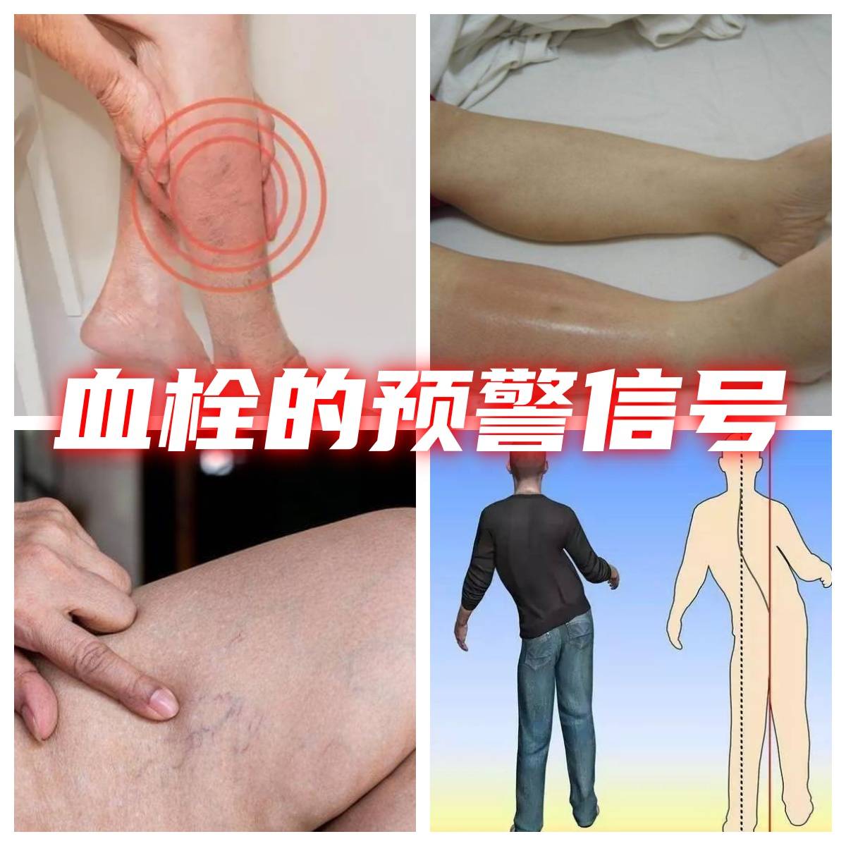 腿部血栓前兆图片