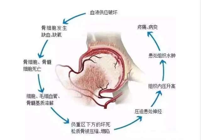 扭伤,摔伤,髋关节脱位,髋臼发育不全容易发生股骨头坏死,骨折手术后