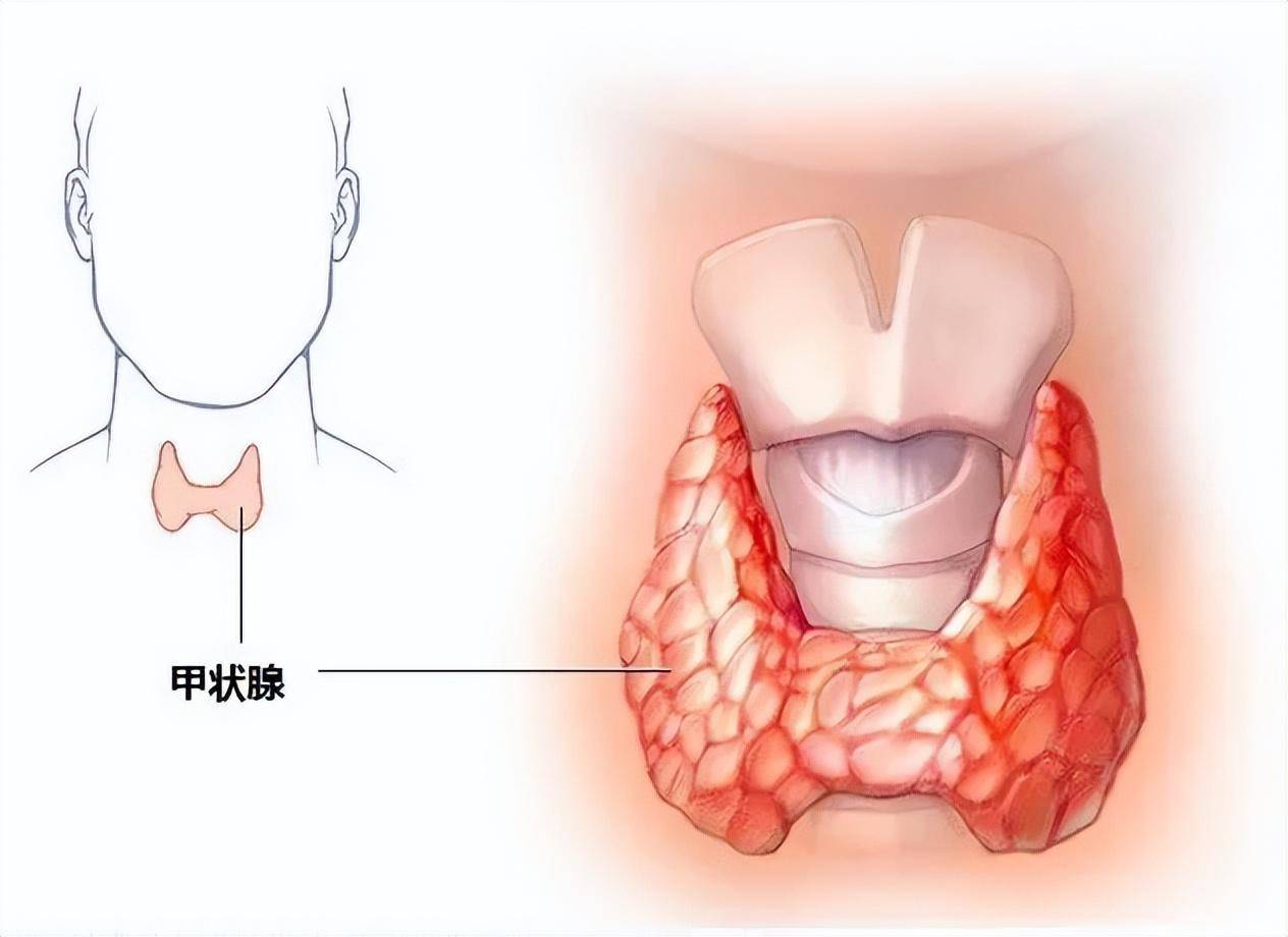 不留疤痕的甲状腺手术,守护你的"天鹅颈"