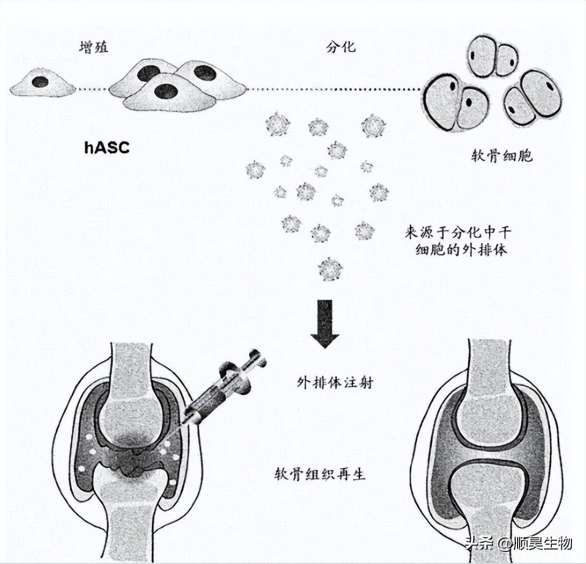 临床真实案例:干细胞治疗膝骨关节炎安全有效!