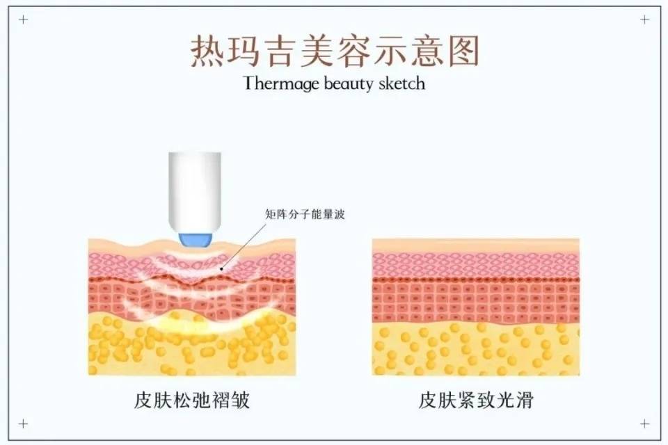 热玛吉副作用图片