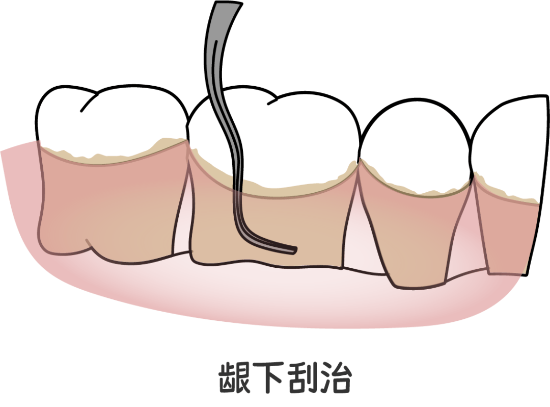 龈下刮治非常痛苦图片