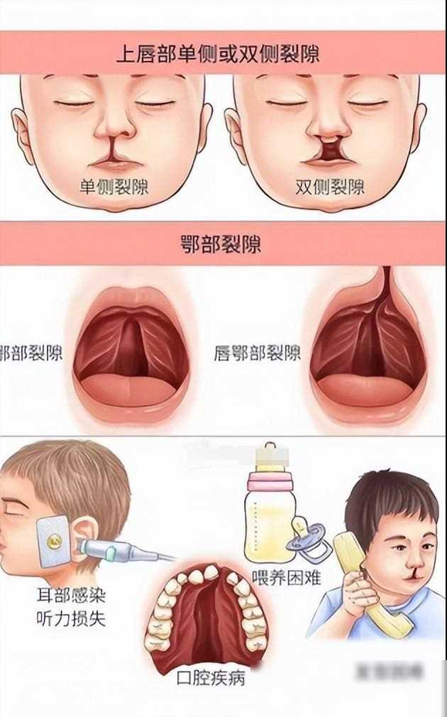 为什么会兔唇的孩子