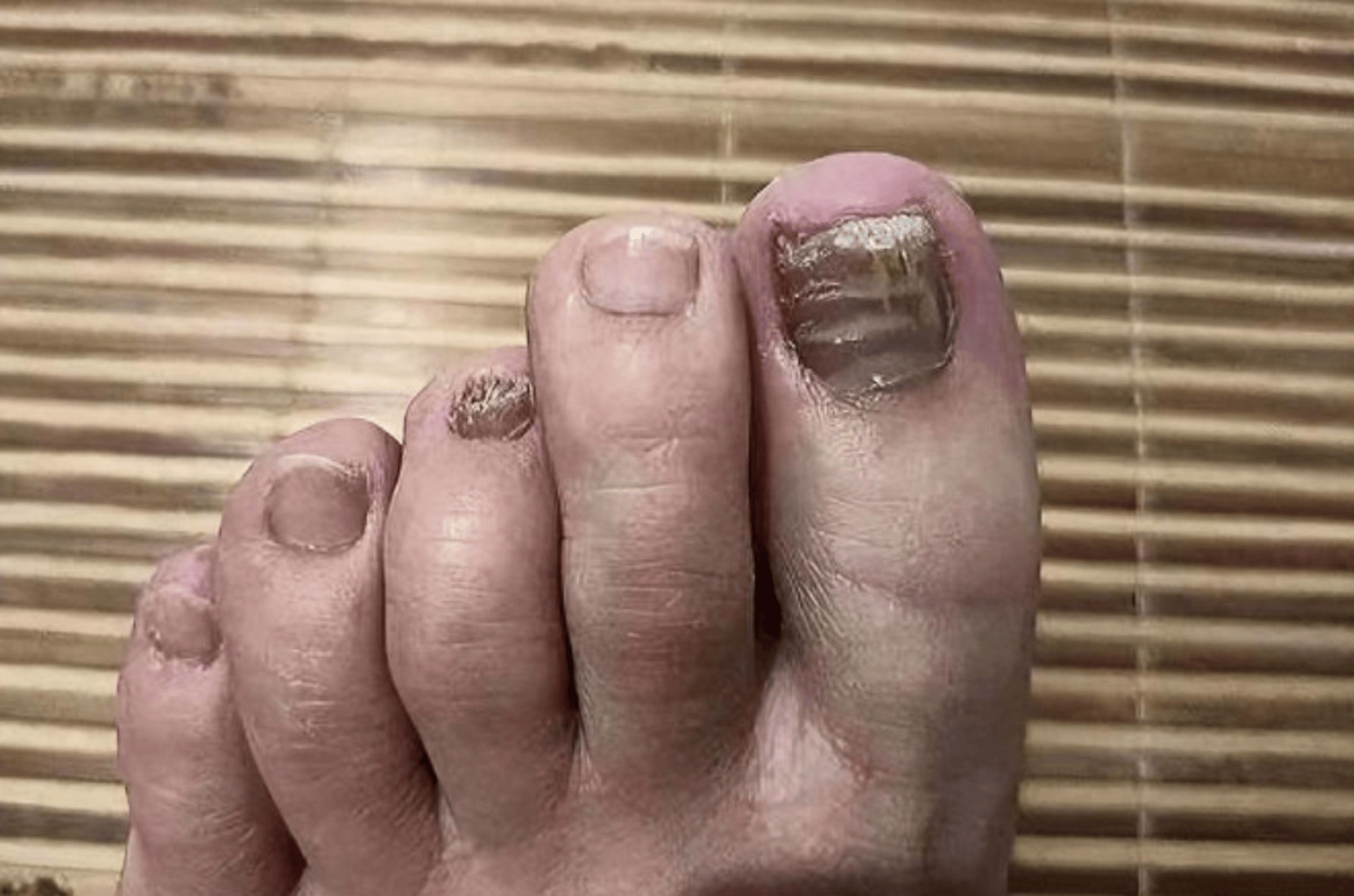 后面无意间看到一个网友分享了自己灰指甲恢复的帖子,我当时正好也没