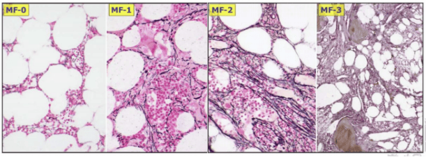 观察还是服药哪个治疗方案更适合大咖细谈制定mf治疗方案的必做检查