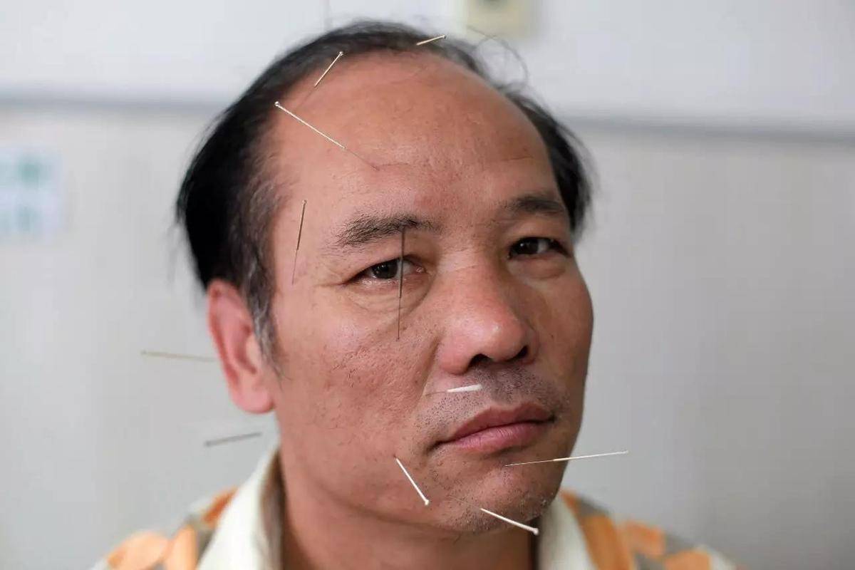 重拾笑容郴州百恩百中医非遗治面瘫奇迹故事资兴纪实
