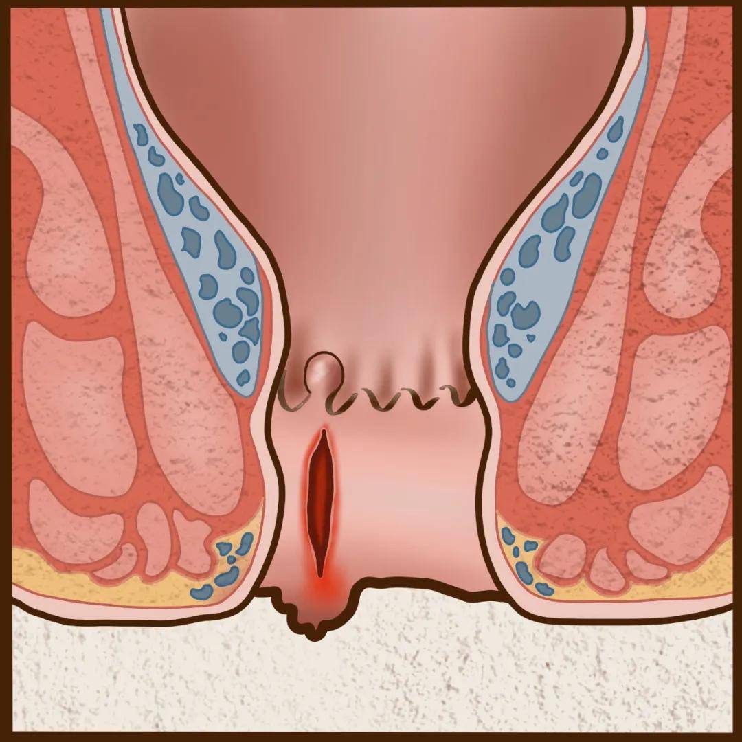 外痔疮会出血吗图片