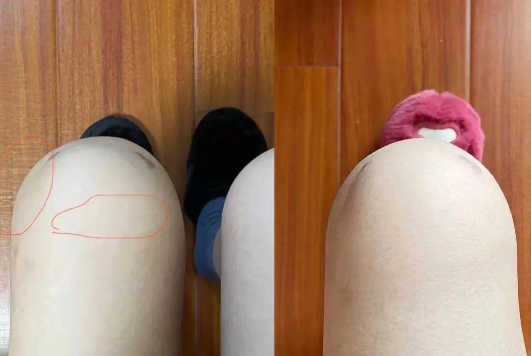 腰突不用做手术康复者在线分享痊愈妙招1周消除腰疼腿麻