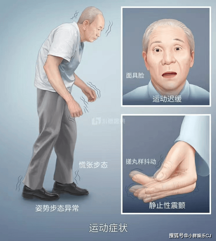 章泽天亮相科学典礼,曝家族有帕金森基因,睡眠不足喝咖啡会发抖