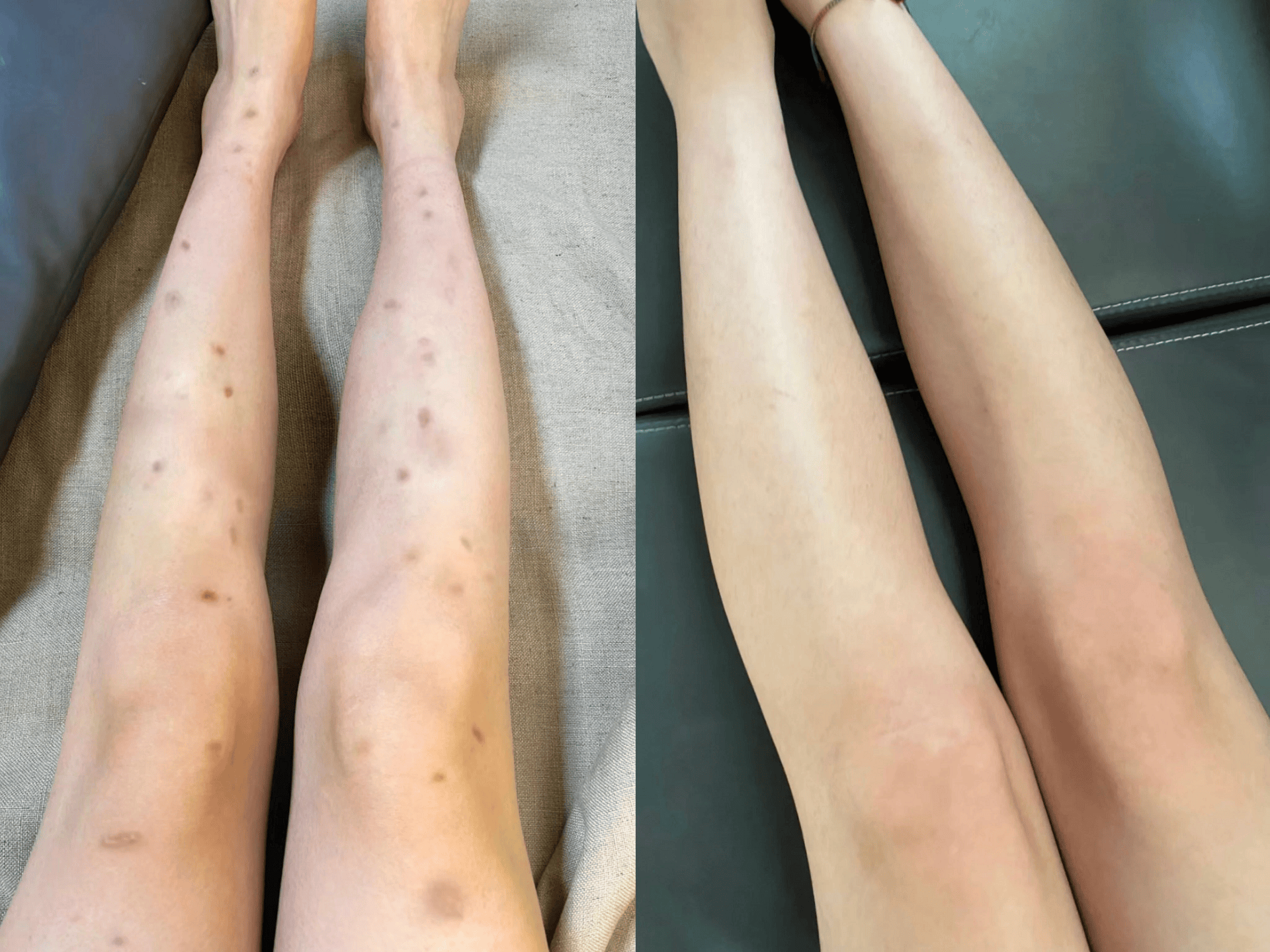 满腿色素疤痕真的太丑了,夏天连裙子都不好意思穿!