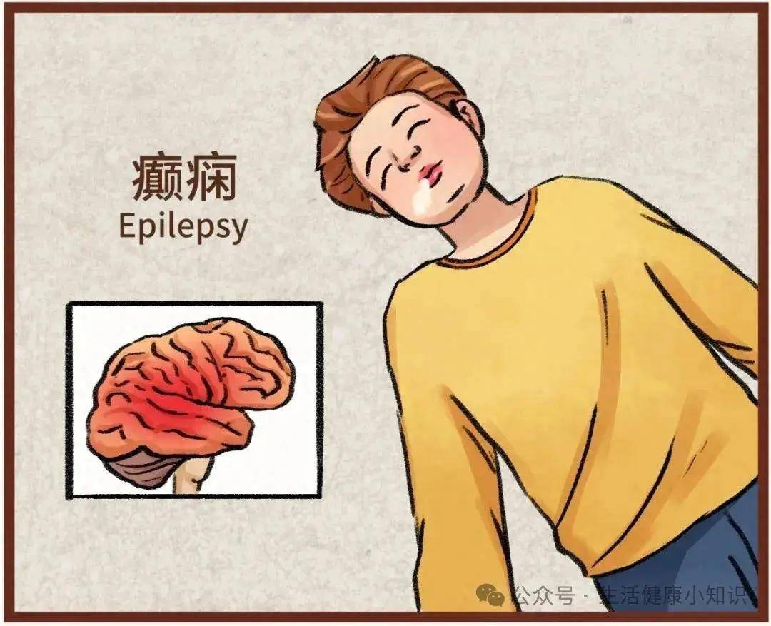 癫痫,俗称"羊癫疯",是一种神经系统慢性疾病,以脑部神经元过度放电
