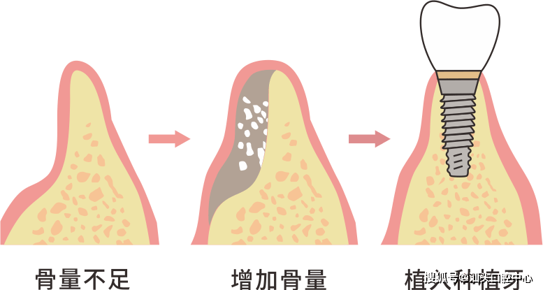 [2]魏宁,朱国威. 拔牙后牙槽骨愈合的影响因素 [j].