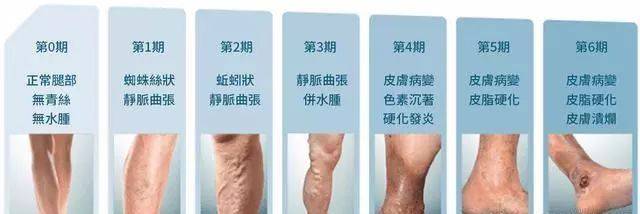 治疗静脉曲张手术需要多少钱 陕西冶金医院血管外科