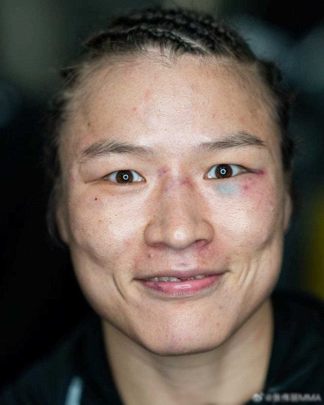 张伟丽晒ufc赛前赛后对比照,眼眶淤青发文:一切安好,加油!