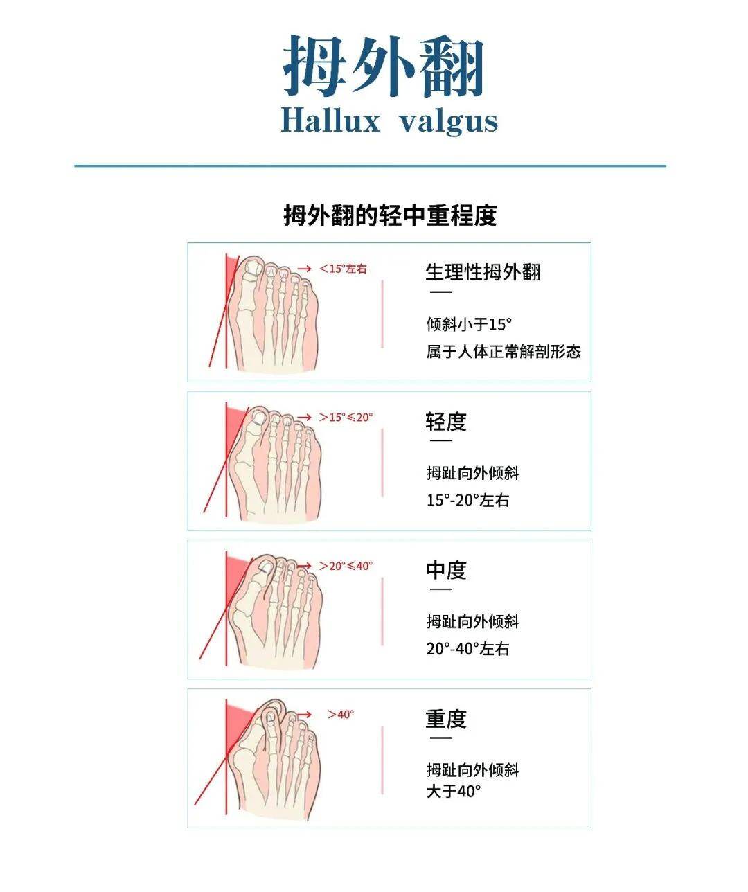 拇外翻最佳治疗方法图片