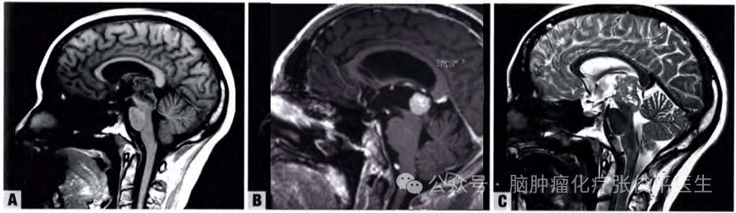 松果体肿瘤一般多大图片