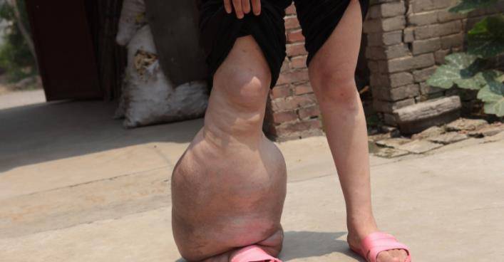 河南巨腿女孩:拖34斤瘤子生活多年,22岁将其锯下,结婚生子