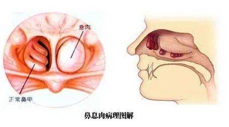 鼻炎患者的鼻腔内部图图片