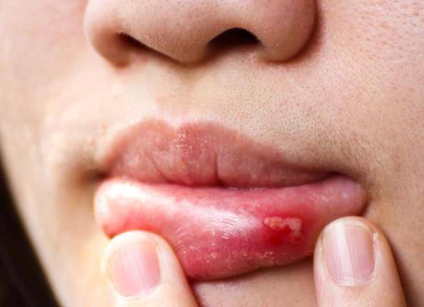 有些全身隐患发作也表现出现口腔溃疡的症状,如内分泌紊乱,脏腑功能