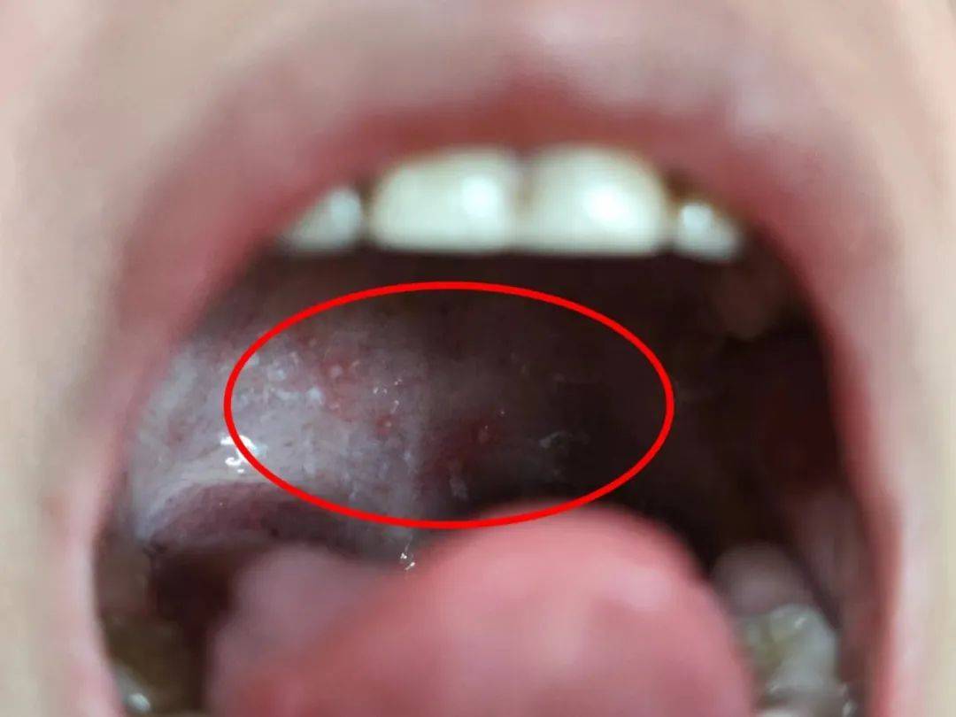 儿童咽部疱疹图片图片