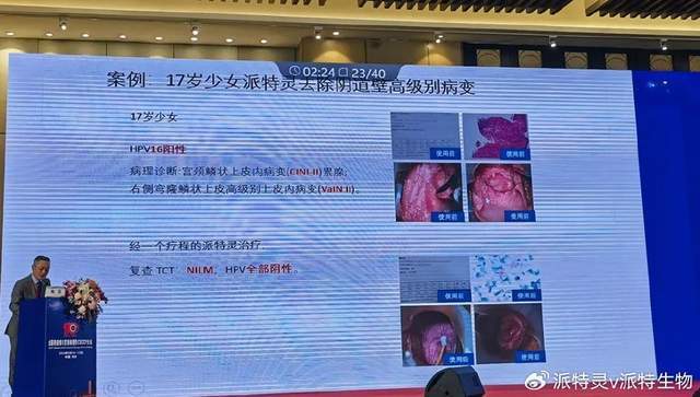 第十届全国阴道镜与宫颈病理学(csccp)大会上,派特灵获得众多专家认可