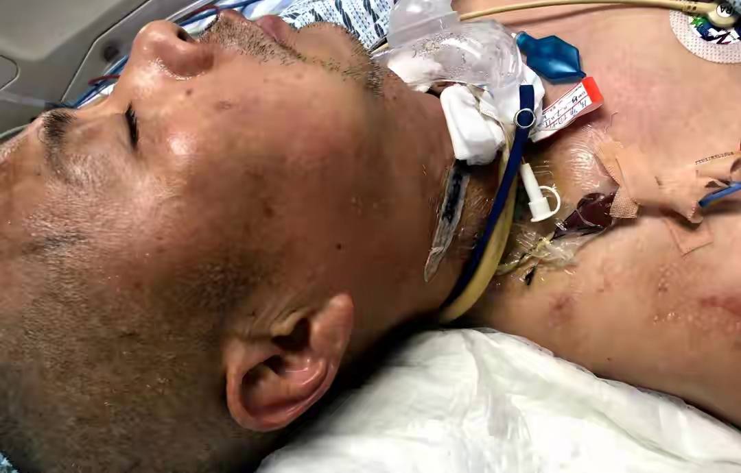 大多数电击伤发生在四肢及脏器,脑干出血与电击伤之间的关联也让人