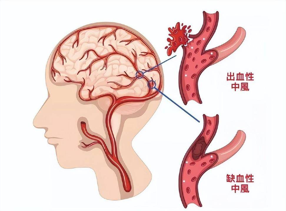 脑出血图片卡通图片