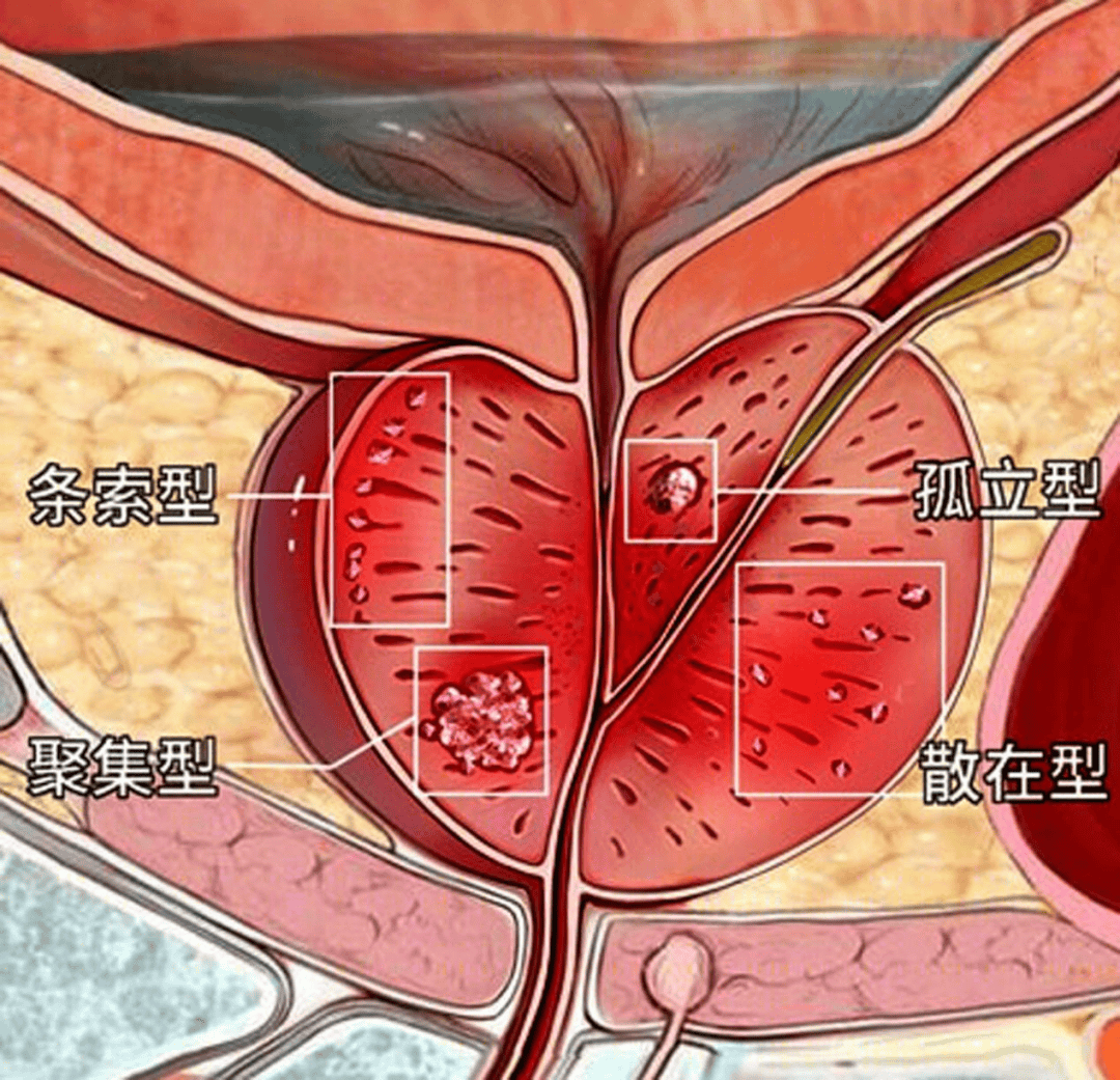 前列腺钙化图解图片