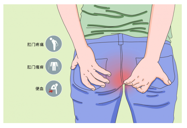 贵阳东大肛肠医院:肛门总是湿湿的,还有分泌物!正常吗?