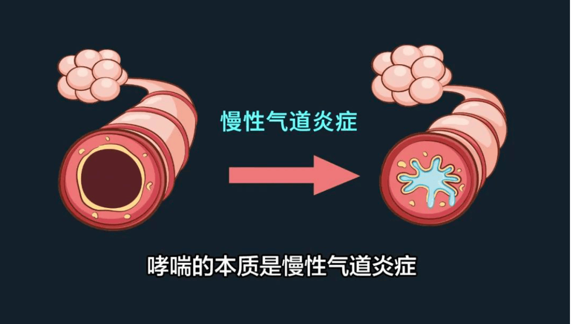 呼吸健康:支气管哮喘越治越严重?可能是中了这几个治疗误区!