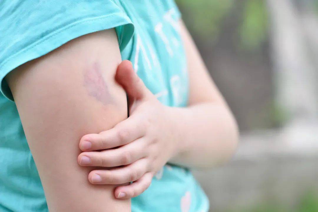 身上莫名出现「淤青」是怎么回事?