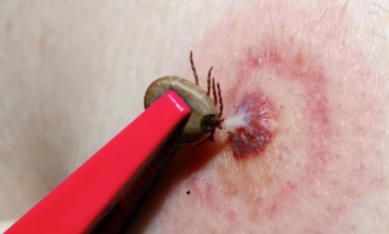 小虫子,大危害——小心夺命蜱虫