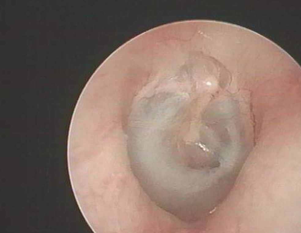 小儿中耳炎症状虽然不典型,儿科医生告诉6条警告症状,有助识别_宝宝