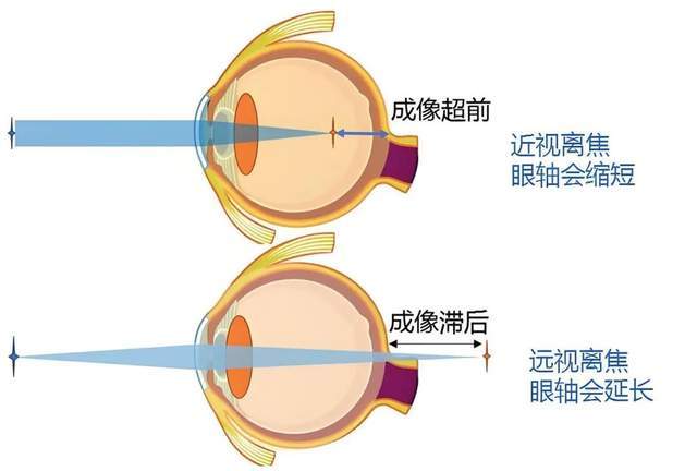 视疲劳是导致近视的主要原因,也可通过调节训练来预防_孩子_眼睛_光源
