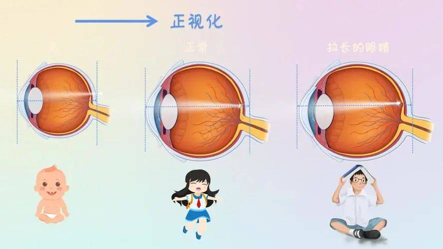 16岁眼睛近视500度图片